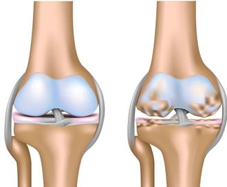 artroza osteoartrita